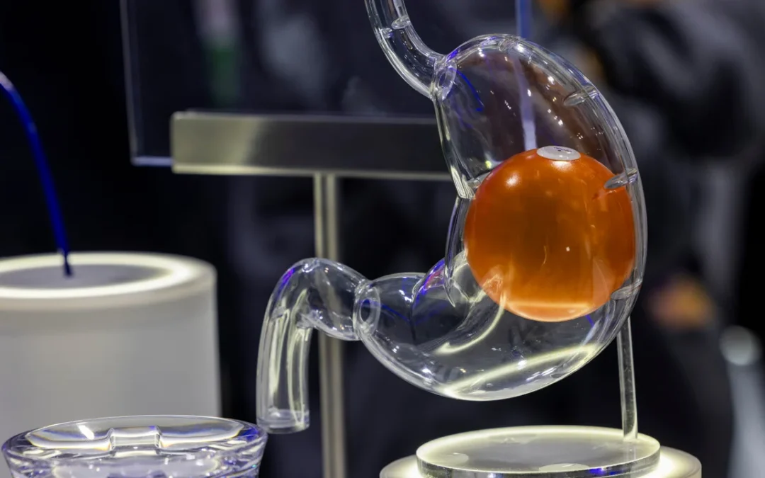 Estudios del Balón Gástrico: Explorando Opciones de Pérdida de Peso No Quirúrgicas